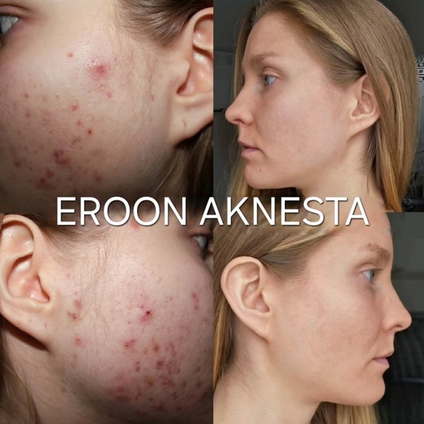 Product image of  Eroon aknesta (ryhmävalmennus)